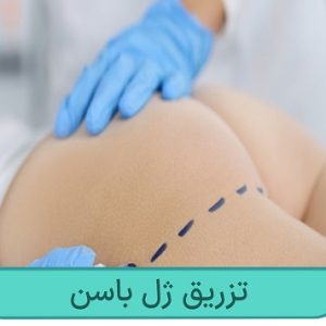 تزریق ژل باسن